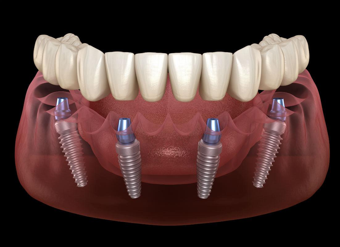 All On 4 Implants Clinton, CT