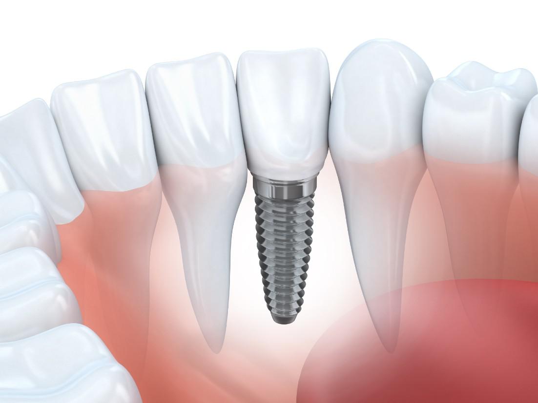Dental Implants Clinton CT